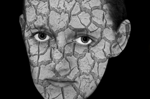 Czas na psychodermatologię Zdrowie, LIFESTYLE - Lekarze mający do czynienia z chorobami skóry coraz częściej zdają sobie sprawę z tego, że samo leczenie dermatologiczne w wielu przypadkach nie wystarczy. W terapii konieczny jest udział specjalisty od zaburzeń psychicznych.