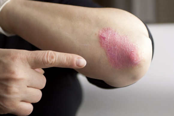 Darmowe konsultacje dermatologiczne w Renew Clinic