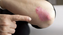 Darmowe konsultacje dermatologiczne w Renew Clinic Zdrowie, LIFESTYLE - ​Choć nie można się nią zarazić, ale jest wyjątkowo uciążliwa dla chorego. Niestety, jak dotąd nie opracowano sposobu na całkowite wyleczenie.