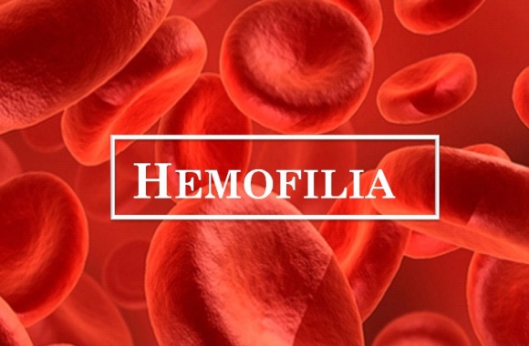 Hemofilia – co wiemy o tej chorobie? Zdrowie, LIFESTYLE - Odpowiedzi na pytanie o hemofilię, postawione podczas sondy ulicznej mogą zaskakiwać. Polacy nie mają dużej wiedzy na jej temat, chociaż jest to jedna z najczęstszych skaz krwotocznych i najwcześniej rozpoznawanych chorób genetycznych.