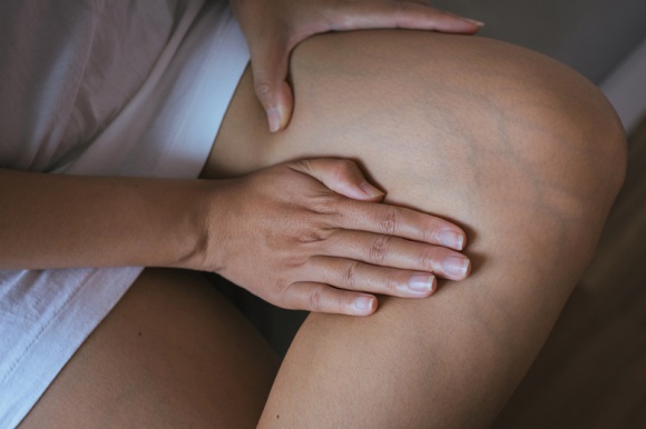 Czy wiesz, że żylaki nóg to dolegliwość dziedziczna? Zdrowie, LIFESTYLE - Żylaki a genetyka