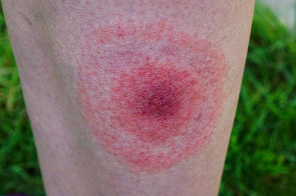 Borelioza - objawy, przyczyny i leczenie Zdrowie, LIFESTYLE - Borelioza to zakaźna choroba wywołana przez bakterie - krętki Borrelia burgdorferi przenoszone przez kleszcze.